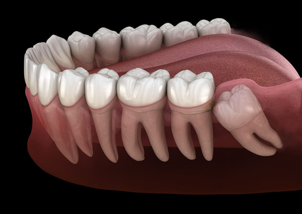 Yirmilik Diş Çekimi — Vural Dental